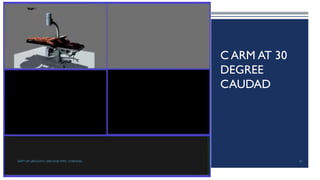 C ARM AT 30
DEGREE
CAUDAD
83
DEPT OF UROLOGY, GRH AND KMC, CHENNAI.
 