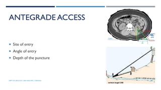 ANTEGRADE ACCESS
 Site of entry
 Angle of entry
 Depth of the puncture
87
DEPT OF UROLOGY, GRH AND KMC, CHENNAI.
 