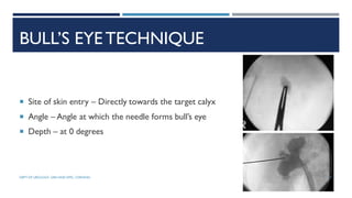 BULL’S EYE TECHNIQUE
 Site of skin entry – Directly towards the target calyx
 Angle – Angle at which the needle forms bull’s eye
 Depth – at 0 degrees
91
DEPT OF UROLOGY, GRH AND KMC, CHENNAI.
 