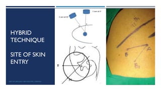 HYBRID
TECHNIQUE
SITE OF SKIN
ENTRY
95
DEPT OF UROLOGY, GRH AND KMC, CHENNAI.
 