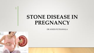 STONE DISEASE IN
PREGNANCY
1
DR ANEES PUTHAWALA
 