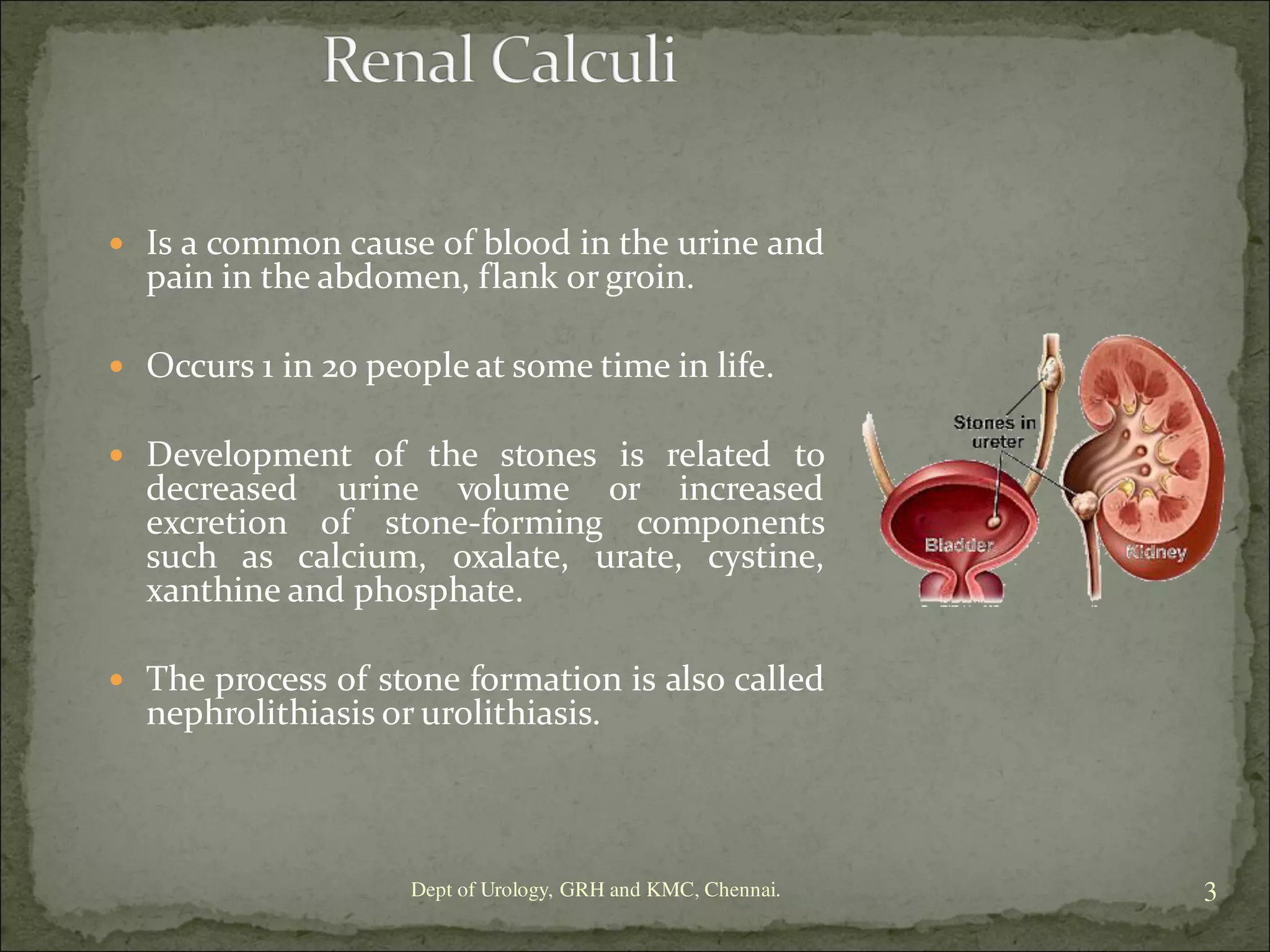 Urolithiasis: Renal calculi rsd