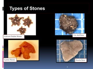 ©
Types of Stones
Calcium Oxalate Stones
Uric Acid Stone
Cystine Stones Struvite Stone
 