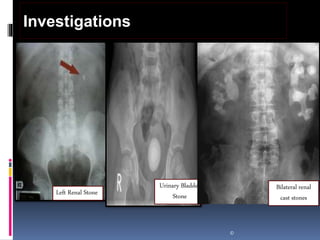 ©
Investigations
Left Renal Stone
Urinary Bladder
Stone
Bilateral renal
cast stones
 