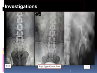 ©
Investigations
Right Upper Ureteric StoneKUB IVP
 