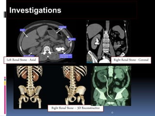 ©
Investigations
Left Renal Stone - Axial Right Renal Stone - Coronal
Right Renal Stone – 3D Reconstructive
 