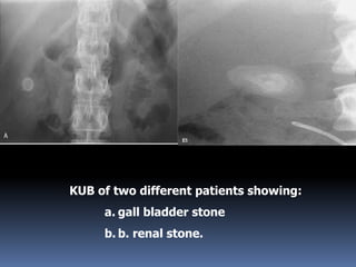 KUB of two different patients showing:
a. gall bladder stone
b. b. renal stone.
 