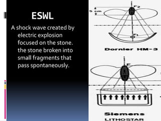 ESWL
A shock wave created by
electric explosion
focused on the stone.
the stone broken into
small fragments that
pass spontaneously.
 