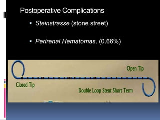 Postoperative Complications
 Steinstrasse (stone street)
 Perirenal Hematomas. (0.66%)
 