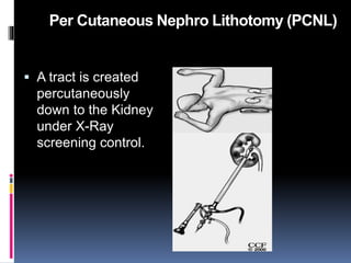 Per Cutaneous Nephro Lithotomy (PCNL)
 A tract is created
percutaneously
down to the Kidney
under X-Ray
screening control.
 