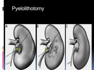 Pyelolithotomy
 