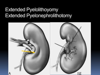 Extended Pyelolithoyomy
Extended Pyelonephrolithotomy
 