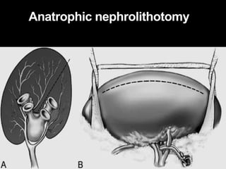 Anatrophic nephrolithotomy
 