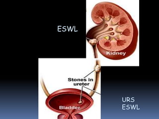 ESWL
URS
ESWL
 