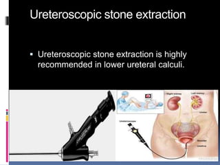 Ureteroscopic stone extraction
 Ureteroscopic stone extraction is highly
recommended in lower ureteral calculi.
 