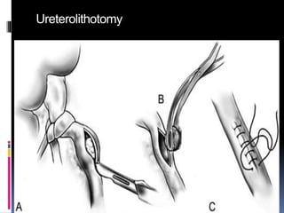 Ureterolithotomy
 