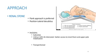 Simple Flank Incision UROLITHIASIS, FAYYEE.pptx