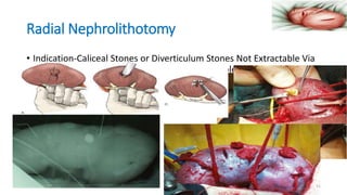 UROLITHIASIS, FAYYEE.pptx