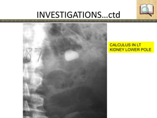 INVESTIGATIONS…ctd
CALCULUS IN LT
KIDNEY LOWER POLE
 