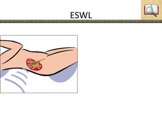 ESWL
 