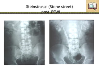 Steinstrasse (Stone street)
- post ESWL
 