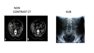 NON
CONTRAST CT KUB
 