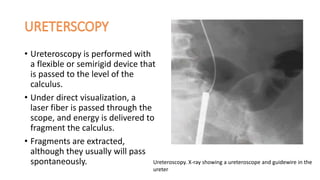 • Ureteroscopy is performed with
a flexible or semirigid device that
is passed to the level of the
calculus.
• Under direct visualization, a
laser fiber is passed through the
scope, and energy is delivered to
fragment the calculus.
• Fragments are extracted,
although they usually will pass
spontaneously. Ureteroscopy. X-ray showing a ureteroscope and guidewire in the
ureter
 