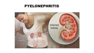 PYELONEPHRITIS
 