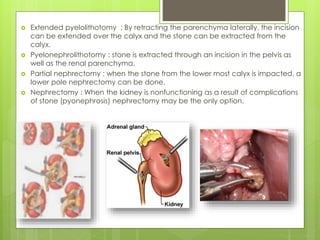 Urolithiasis s unnex | PPTX