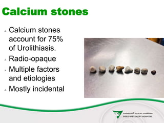  Calcium stones
account for 75%
of Urolithiasis.
 Radio-opaque
 Multiple factors
and etiologies
 Mostly incidental
Calcium stones
 