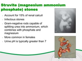  Account for 15% of renal calculi
 Infectous stones
 Gram-negative rods capable of
splitting urea into ammonium, which
combines with phosphate and
magnesium
 More common in females
 Urine pH is typically greater than 7
Struvite (magnesium ammonium
phosphate) stones
 