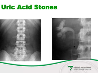 Uric Acid Stones
 
