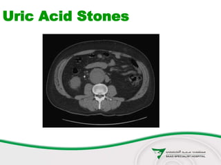 Uric Acid Stones
 