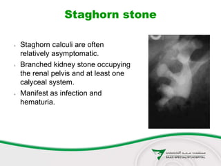  Staghorn calculi are often
relatively asymptomatic.
 Branched kidney stone occupying
the renal pelvis and at least one
calyceal system.
 Manifest as infection and
hematuria.
Staghorn stone
 