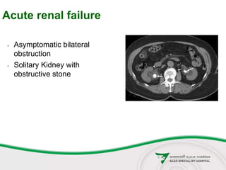 Acute renal failure
 Asymptomatic bilateral
obstruction
 Solitary Kidney with
obstructive stone
 
