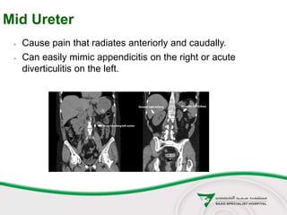 Mid Ureter
 Cause pain that radiates anteriorly and caudally.
 Can easily mimic appendicitis on the right or acute
diverticulitis on the left.
 