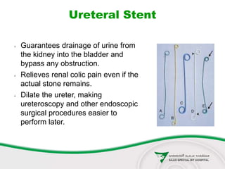 Ureteral Stent
 Guarantees drainage of urine from
the kidney into the bladder and
bypass any obstruction.
 Relieves renal colic pain even if the
actual stone remains.
 Dilate the ureter, making
ureteroscopy and other endoscopic
surgical procedures easier to
perform later.
 