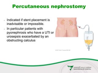 Percutaneous nephrostomy
 Indicated if stent placement is
inadvisable or impossible.
 In particular patients with
pyonephrosis who have a UTI or
urosepsis exacerbated by an
obstructing calculus
 