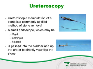 Ureteroscopy
 Ureteroscopic manipulation of a
stone is a commonly applied
method of stone removal
 A small endoscope, which may be
 Rigid
 Semirigid
 Flexible
 is passed into the bladder and up
the ureter to directly visualize the
stone
 