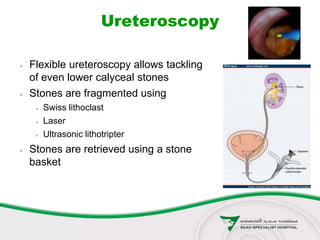 Ureteroscopy
 Flexible ureteroscopy allows tackling
of even lower calyceal stones
 Stones are fragmented using
 Swiss lithoclast
 Laser
 Ultrasonic lithotripter
 Stones are retrieved using a stone
basket
 