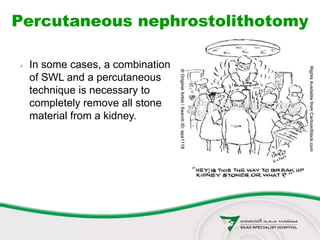 Percutaneous nephrostolithotomy
 In some cases, a combination
of SWL and a percutaneous
technique is necessary to
completely remove all stone
material from a kidney.
 