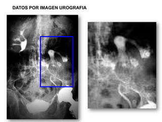 DATOS POR IMAGEN UROGRAFIA
 