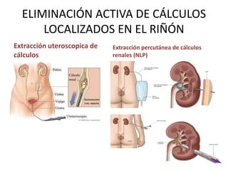ELIMINACIÓN ACTIVA DE CÁLCULOS 
LOCALIZADOS EN EL RIÑÓN 
Extracción uteroscopica de 
cálculos 
Extracción percutánea de cálculos 
renales (NLP) 
 