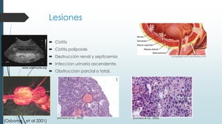 Lesiones
 Cistitis
 Cistitis polipoide
 Destrucción renal y septicemia
 Infeccion urinaria ascendente.
 Obstruccion parcial o total.
urologiaperuana.wordpress.com
(Osborne., et al 2001)
1 2
(Xambre el tal., 2003)(Xambre el tal., 2003)
www.veterinaria.org
 