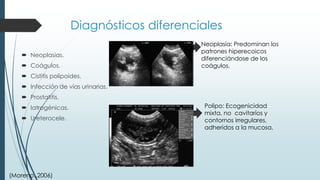 Diagnósticos diferenciales
 Neoplasias.
 Coágulos.
 Cistitis polipoides.
 Infección de vías urinarias.
 Prostatitis.
 Iatrogénicas.
 Ureterocele.
Neoplasia: Predominan los
patrones hiperecoicos
diferenciándose de los
coágulos.
Polipo: Ecogenicidad
mixta, no cavitaríos y
contornos irregulares,
adheridos a la mucosa.
(Moreno.,2006)
 