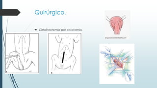 Quirúrgico.
 Cistolitectomia por cistotomia.
 