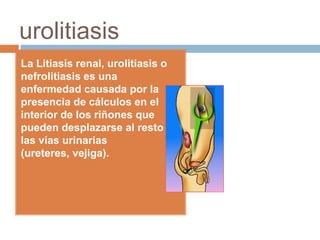 urolitiasis La Litiasis renal, urolitiasis o nefrolitiasis es una enfermedad causada por la presencia de cálculos en el interior de los riñones que pueden desplazarse al resto de las vías urinarias (ureteres, vejiga).  