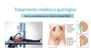 Tratamiento medico y quirúrgico
litotricia extracorpórea por ondas de choque (SWL)
 