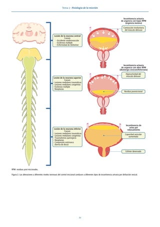 Tema 2 · Fisiología de la micción
21
RPM: residuos post-miccionales.
Figura 2. Las alteraciones a diferentes niveles nerviosos del control miccional conducen a diferentes tipos de incontinencia urinaria por disfunción vesical.
Lesión de la neurona superior
Causas:
- Lesiones medulares traumáticas
- Lesiones medulares congénitas
- Esclerosis múltiple
- Neoplasias
Lesión de la neurona inferior
Causas:
- Lesiones medulares traumáticas
- Lesiones medulares congénitas
- Traumatismos quirúrgicos
- Neoplasias
- Compresión extrínseca
(hernia de disco)
Lesión de la neurona central
Causas:
- Accidente cerebrovascular
- Esclerosis múltiple
- Enfermedad de Alzheimer
Incontinencia urinaria
de urgencia con bajos RPM
(urgencia motora)
Incontinencia urinaria
de urgencia con altos RPM
(disinergia vesicoesfinteriana)
Incontinencia de
orina por
rebosamiento
Residuo posmiccional
Esfínter denervado
Contracción involuntaria
del músculo detrusor
Hiperactividad del
músculo detrusor
Capacidad vesicular
aumentada
 