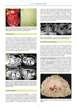 Tema 5 · Infecciones urinarias
31
Absceso renal
Generalmente producidos por infección ascendente, aunque
en ocasiones se produce por siembra hematógena desde un
foco a distancia. La etiología más habitual de este último es S.
aureus, teniendo en este caso localización cortical. El trata-
miento consiste en pautas antibióticas intravenosas prolonga-
das y el drenaje percutáneo o quirúrgico de la colección. En
ocasiones los abscesos se abren a vía urinaria provocando la
aparición de abundante pus en el sedimento, o al espacio peri-
nefrítico, pudiendo implicar estructuras adyacentes al riñón,
con el consiguiente agravamiento del cuadro.
Prostatitis aguda
La causa más frecuente sigue siendo E. coli (MIR). Cursa con
dolor perineal o lumbar bajo bilateral, fiebre, disuria y, ocasio-
nalmente, dolor en la eyaculación. El tacto rectal es obligatorio,
existiendo una próstata congestiva, tumefacta, caliente y dolo-
rosa. El masaje prostático o la instrumentación uretral están
contraindicados. En el sedimento aparece piuria y el cultivo
puede ser estéril. Si existe grave afectación del estado general
es preciso el ingreso hospitalario. El tratamiento debe realizarse
bajo las mismas premisas que cualquier infección parenquima-
tosa genitourinaria y prolongarse durante 1 mes
(MIR 18, 137). En el caso de ausencia de respuesta a una
pauta antibiótica correcta está indicado el estudio mediante TC
o ecografía para descartar la presencia de un absceso prostáti-
co; caso en el cual sería electiva la realización de un drenaje del
mismo por punción transrectal.
Prostatitis crónica bacteriana
Cursa de manera menos florida, con molestias perineales o
genitales, polaquiuria, tenesmo, disuria y episodios de ITU
recurrentes (mismo germen). En el líquido obtenido tras masa-
je prostático (test de Stamey) aparecen más de 10 leucocitos
por campo y macrófagos con cuerpos ovales grasos. En la
ecografía pueden observarse calcificaciones intraprostáticas
diseminadas. El tratamiento debe realizarse según el resultado
del antibiograma y mantenerse durante 2 meses.
Si los cultivos son negativos y el curso más larvado, se habla de
prostatitis crónica abacteriana, debiendo realizar tratamien-
to empírico con doxiciclina o eritromicina, pues en muchas
ocasiones el germen responsable puede ser U. urealiticum o M.
hominis. La prostatodinia es un cuadro similar, pero en el que
se objetivan menos de 10 leucocitos en el líquido obtenido tras
masaje prostático. Su causa es desconocida y el tratamiento,
poco eficaz, consiste en alfabloqueantes, fitoterapia y/o rela-
jantes musculares. Últimamente se aboga por eliminar el térmi-
no de prostatodinia, ya que la sintomatología se encuentra
dentro del denominado síndrome de dolor pélvico crónico.
Figura 4. La TC es una herramienta ideal para la valoración de los casos con
infección urinaria complicada. A. Pionefrosis litiásica en el riñón izquierdo.
B. Nefronía lobar o pielonefritis focal aguda bacteriana. C. Absceso renal en
paciente portadora de catéter doble J derecho. D. Absceso peri y pararrenal con
afectación del psoas.
A B
C D
Figura 5. Absceso prostático en varón afecto de prostatitis aguda con fiebre
intensa y mala evolución clínica, puesto en evidencia mediante ecografía.
Figura 6. Prostatitis crónica con calcificaciones intraprostáticas en estudio de
autopsia.
A B
Figura 3. A. Estigmas morfológicos de la pielonefritis crónica a nivel macros-
cópico con áreas de cicatriz cortical. B. Y a nivel microscópico con áreas de
desestructuración, atrofia y tiroidización del parénquima renal.
 